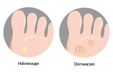 Wie erkennt man ein Hühnerauge? Merkmale und Unterscheidung von Warzen Wie erkennt man ein Hühnerauge? Merkmale und Unterscheidung von Warzen