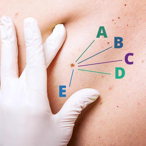 Hautkrebsprävention: Tipps zur Vermeidung von Hautkrebs und Muttermalen Hautkrebsprävention: Tipps zur Vermeidung von Hautkrebs und Muttermalen