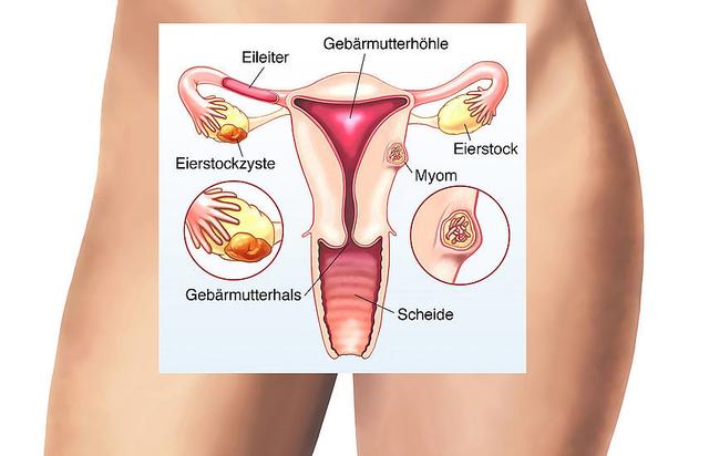 Myome in der Gebärmutter: Ursachen, Symptome und Diagnose Myome in der Gebärmutter: Ursachen, Symptome und Diagnose