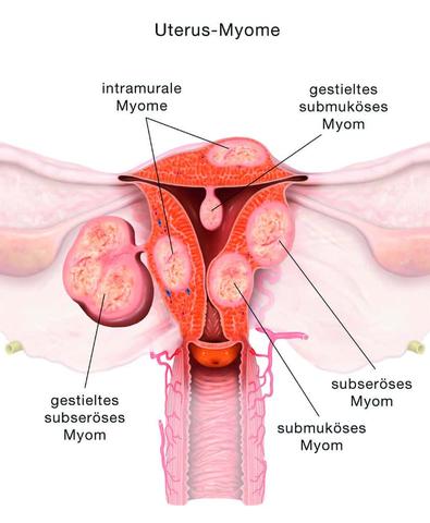 Kann man Myome durch Homöopathie oder Naturheilkunde behandeln? Kann man Myome durch Homöopathie oder Naturheilkunde behandeln?