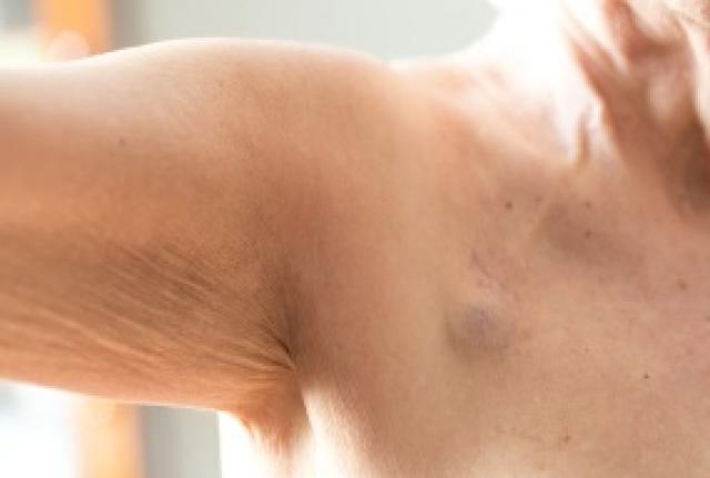 Pflege und Spülung des Ports in Therapiepausen Pflege und Spülung des Ports in Therapiepausen