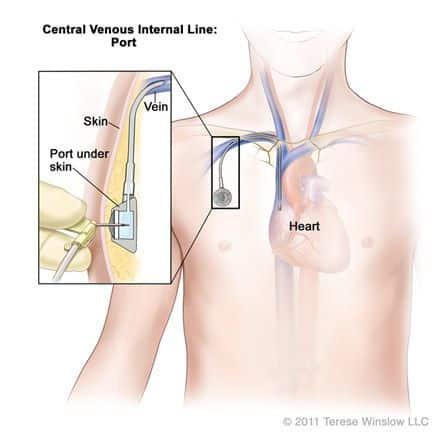 Portsystem bei Chemotherapie: Funktion und Nutzung Portsystem bei Chemotherapie: Funktion und Nutzung