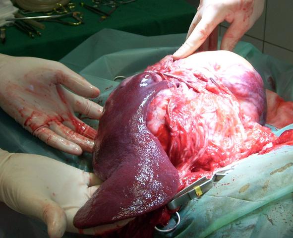 3. Sarkome: Seltene Tumoren mit vielfältigen Unterformen 3. Sarkome: Seltene Tumoren mit vielfältigen Unterformen