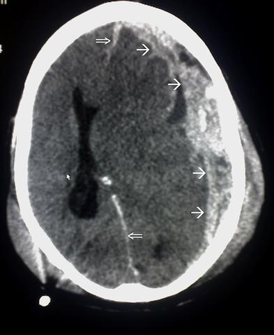 Formen von Schädelfrakturen und Gehirnverletzungen: Ursachen, Symptome und Diagnose Formen von Schädelfrakturen und Gehirnverletzungen: Ursachen, Symptome und Diagnose