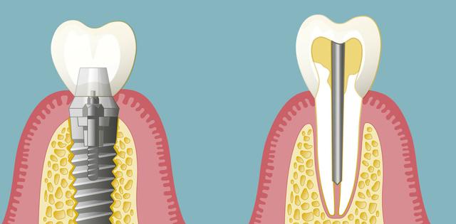 Stiftzahn vs. Implantat: Welche Option passt zu Ihnen? Stiftzahn vs. Implantat: Welche Option passt zu Ihnen?