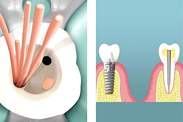 Stiftzahn oder Implantat: Was sollten Sie wissen? Stiftzahn oder Implantat: Was sollten Sie wissen?
