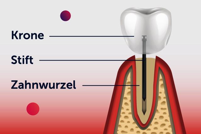 Stiftzähne erklärt: Vor- und Nachteile im Vergleich zu Implantaten Stiftzähne erklärt: Vor- und Nachteile im Vergleich zu Implantaten
