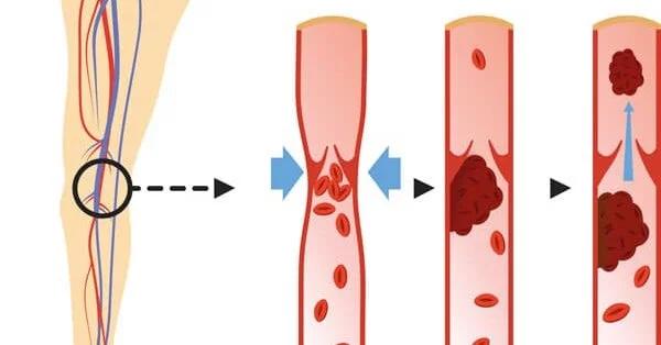 Definition und Entstehung eines Thrombus: Ursachen, Arten und Risikofaktoren