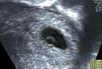 Auswirkungen eines Windeis auf die reproduktive Zukunft der Frau