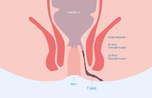 Was verursacht eine Fistel? Symptome und Diagnose