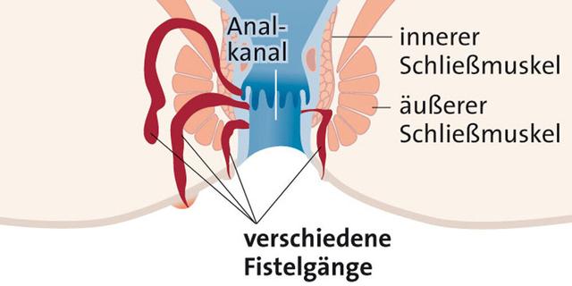 Wo finden Sie Hilfe bei Fistelbeschwerden?