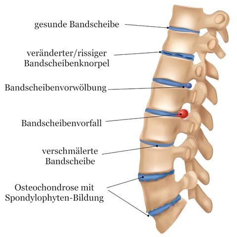 Diagnose und Behandlung von Osteochondrose: Wie wir Ihnen helfen können. Diagnose und Behandlung von Osteochondrose: Wie wir Ihnen helfen können.