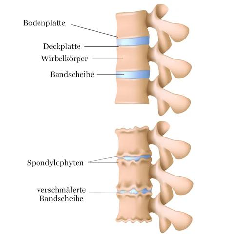 Ursachen und Symptome einer Osteochondrose: Was Sie wissen sollten. Ursachen und Symptome einer Osteochondrose: Was Sie wissen sollten.