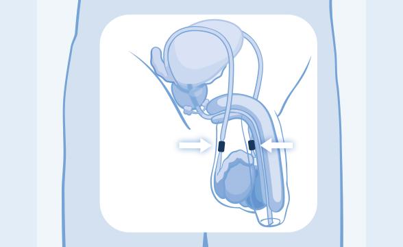 Vasektomie oder Sterilisation der Frau: Welche Methode ist besser?
