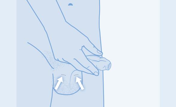 Vor der Vasektomie Spermien einfrieren lassen: Eine Option?