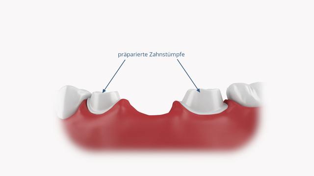 3. Zahnlücken und ihre Auswirkungen auf die Gesundheit 3. Zahnlücken und ihre Auswirkungen auf die Gesundheit