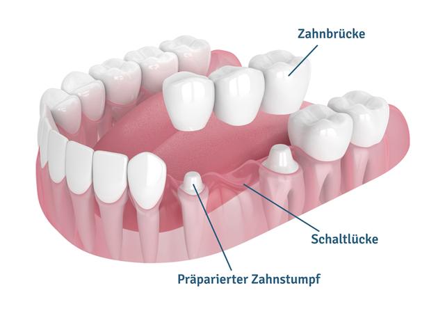 5. Der Herstellungsprozess einer Zahnbrücke 5. Der Herstellungsprozess einer Zahnbrücke