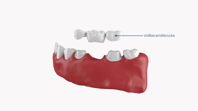 2. Arten von Zahnbrücken: Vollkeramik, Komposit oder Implantat 2. Arten von Zahnbrücken: Vollkeramik, Komposit oder Implantat