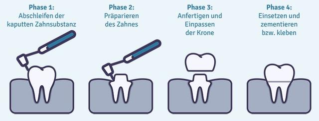Wiedereinsetzen einer ausgefallenen Zahnkrone: Möglichkeiten und Vorgehen Wiedereinsetzen einer ausgefallenen Zahnkrone: Möglichkeiten und Vorgehen