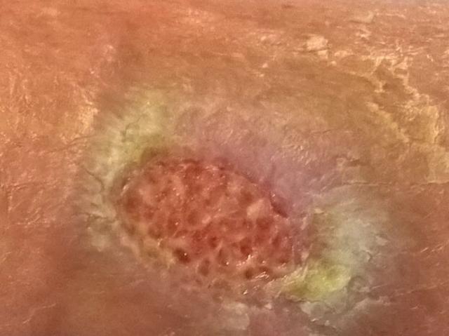 Fibrinbelag bei chronischen Wunden: Ursachen und Behandlungsmöglichkeiten Fibrinbelag bei chronischen Wunden: Ursachen und Behandlungsmöglichkeiten