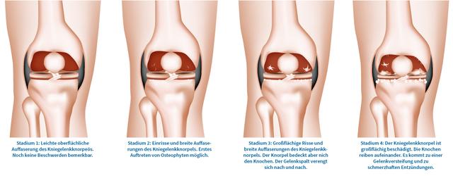 Arthrose im Knie: Stadien, Symptome und Selbstmanagement-Maßnahmen