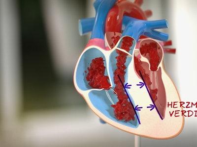Hypertrophie: Auswirkungen auf Muskeln und Herz