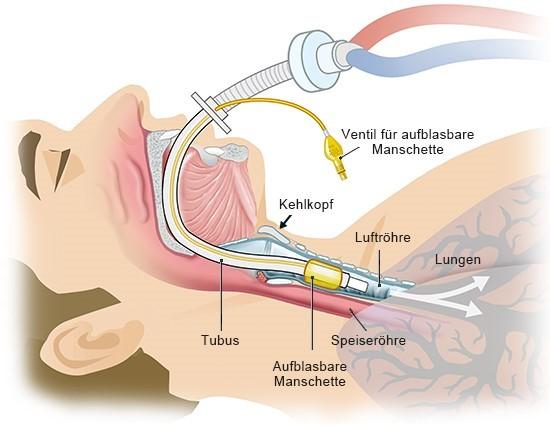 Intubation im Detail: Was ist das und wann wird sie angewendet? Intubation im Detail: Was ist das und wann wird sie angewendet?