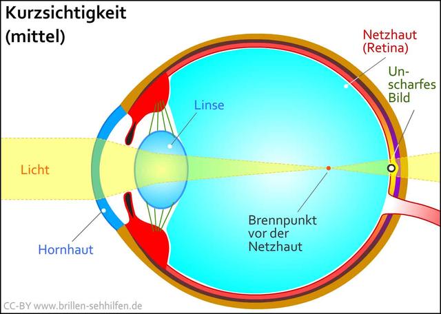 Alles über Kurzsichtigkeit: Ursachen, Symptome und Therapiemöglichkeiten