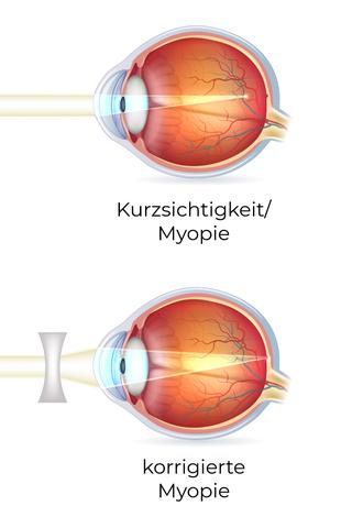 6. Vorbeugung und Vorsorgeuntersuchungen bei Kurzsichtigkeit 6. Vorbeugung und Vorsorgeuntersuchungen bei Kurzsichtigkeit
