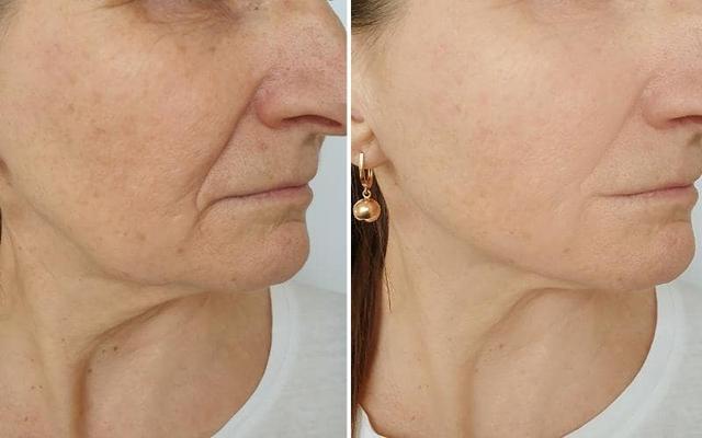 Alles über Mesotherapie: Wirkstoffe, Anwendungsbereiche und Kosten Alles über Mesotherapie: Wirkstoffe, Anwendungsbereiche und Kosten