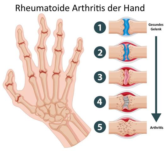 Alles, was Sie über Polyarthritis wissen müssen Alles, was Sie über Polyarthritis wissen müssen