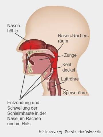 Pseudokrupp bei Säuglingen und Kleinkindern: Anzeichen, Auslöser und Hilfestellungen Pseudokrupp bei Säuglingen und Kleinkindern: Anzeichen, Auslöser und Hilfestellungen