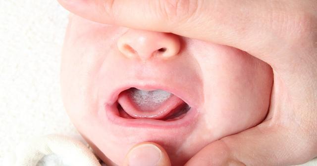 Symptome und Behandlung von Soor bei Babys und Erwachsenen Symptome und Behandlung von Soor bei Babys und Erwachsenen