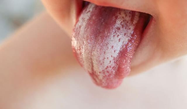 Soor: Ursachen, Symptome und Behandlungsmöglichkeiten Soor: Ursachen, Symptome und Behandlungsmöglichkeiten