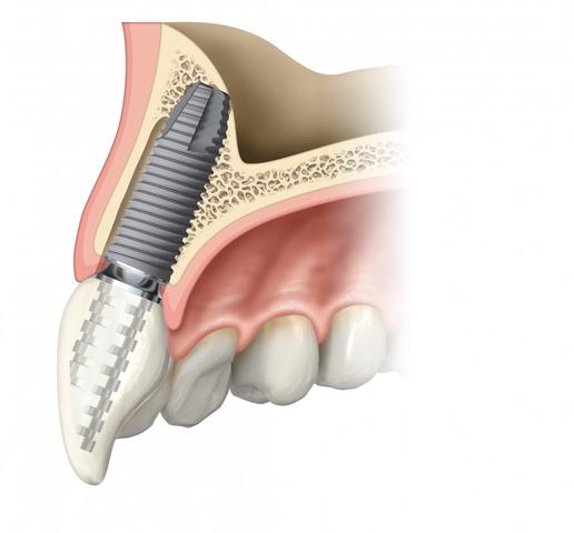 Zusätzliche Kosten bei zahnchirurgischen Eingriffen: Was sollten Sie beachten? Zusätzliche Kosten bei zahnchirurgischen Eingriffen: Was sollten Sie beachten?