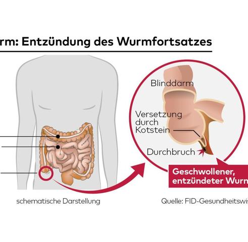 Der Blinddarm: Warum er für die Abwehr von Krankheitserregern wichtig ist