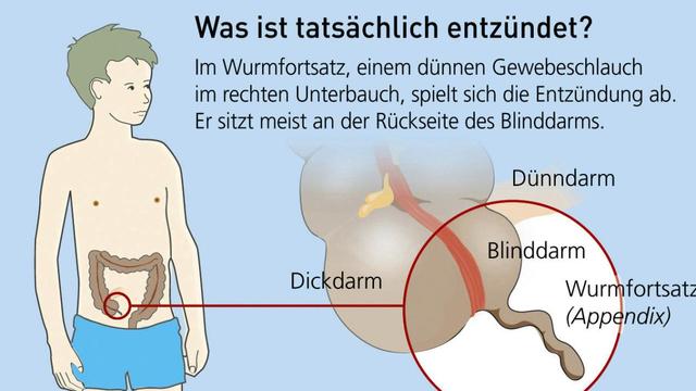 Wichtige Informationen zum Blinddarm: Anatomie und Funktion