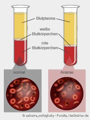 5. Die Auswirkungen von unbehandelter Blutarmut auf die Gesundheit 5. Die Auswirkungen von unbehandelter Blutarmut auf die Gesundheit