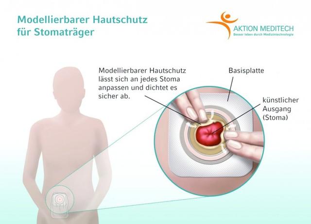 Auswirkungen eines künstlichen Darmausgangs auf den After