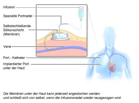 Was passiert nach der letzten Chemotherapie? Die Erholungsphase erklärt Was passiert nach der letzten Chemotherapie? Die Erholungsphase erklärt