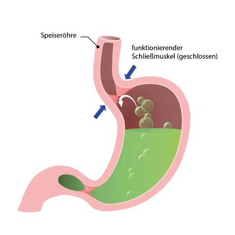 Wie äußert sich Sodbrennen? Erfahren Sie mehr über die typischen Symptome Wie äußert sich Sodbrennen? Erfahren Sie mehr über die typischen Symptome