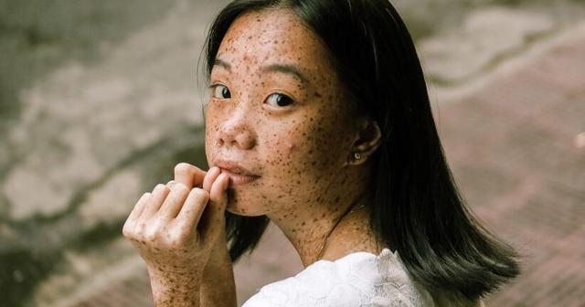 Kostenübernahme für die Behandlung von Muttermalen: Was Sie beachten sollten Kostenübernahme für die Behandlung von Muttermalen: Was Sie beachten sollten