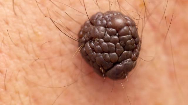 Früherkennung von gefährlichen Muttermalen: Was Sie wissen sollten Früherkennung von gefährlichen Muttermalen: Was Sie wissen sollten