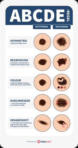 Wie entstehen Muttermale und welche Formen gibt es? Wie entstehen Muttermale und welche Formen gibt es?