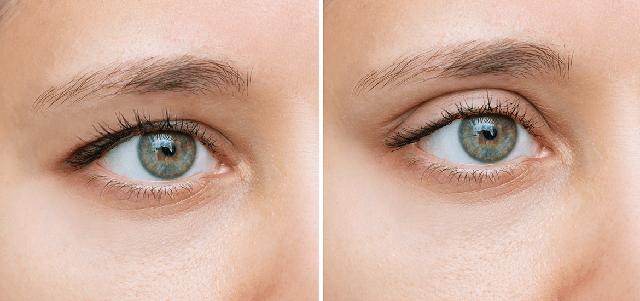 Von Natur aus oder im Alter: Was verursacht Schlupflider und wie kann man sie reduzieren?