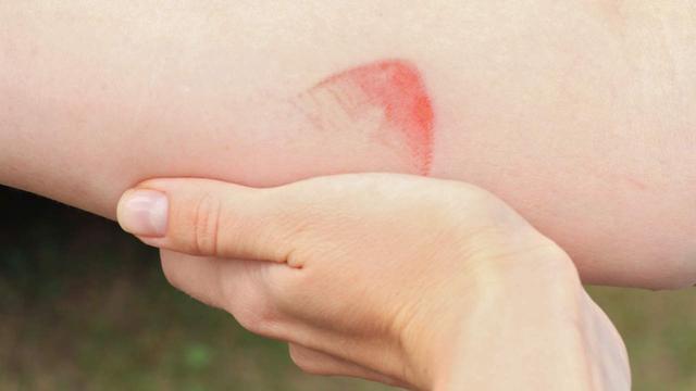 Soforthilfe bei Brandblasen: Die besten Methoden zur Schmerzlinderung