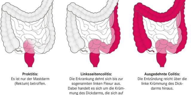 Chronisch-entzündliche Darmerkrankungen: Morbus Crohn und Colitis ulcerosa – Ursachen und Behandlungsmöglichkeiten Chronisch-entzündliche Darmerkrankungen: Morbus Crohn und Colitis ulcerosa – Ursachen und Behandlungsmöglichkeiten
