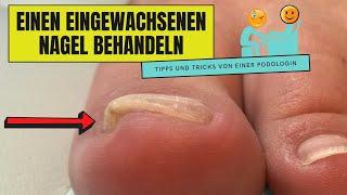 Effektive Lösungen bei einem eingewachsenen Zehennagel: Tipps und Tricks für schnelle Linderung Effektive Lösungen bei einem eingewachsenen Zehennagel: Tipps und Tricks für schnelle Linderung