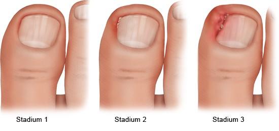 Eingewachsener Zehennagel - Ursachen und wirksame Maßnahmen zur Vorbeugung und Behandlung Eingewachsener Zehennagel - Ursachen und wirksame Maßnahmen zur Vorbeugung und Behandlung