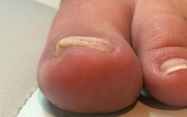 Wie kann man einen eingewachsenen Zehennagel behandeln? Tipps und Empfehlungen Wie kann man einen eingewachsenen Zehennagel behandeln? Tipps und Empfehlungen